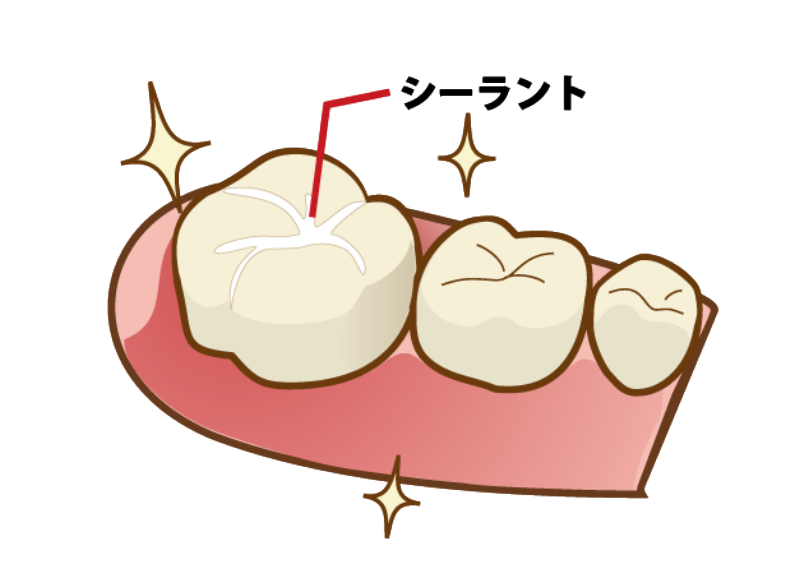 シーラント｜すずき歯科クリニック