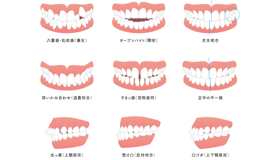 不正咬合の影響｜すずき歯科クリニック