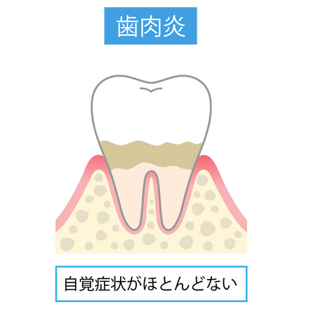 歯周病の進行｜すずき歯科クリニック