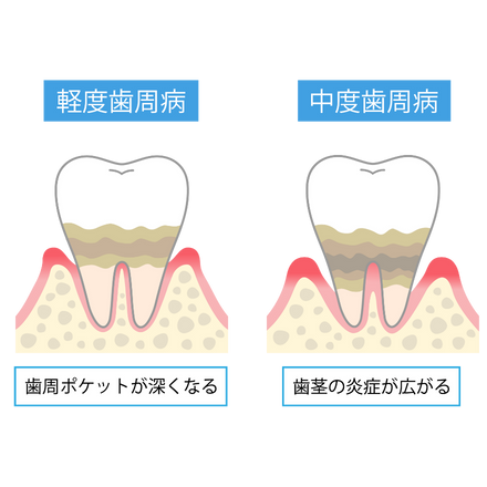 歯周病の進行｜すずき歯科クリニック