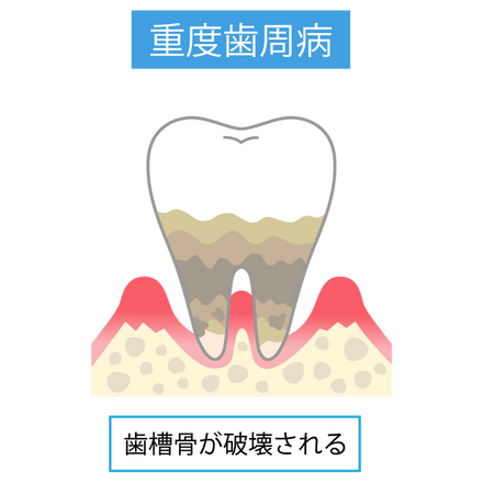 歯周病の進行｜すずき歯科クリニック
