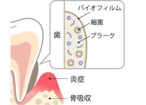 歯周病の原因とリスクを高める要因｜すずき歯科クリニック