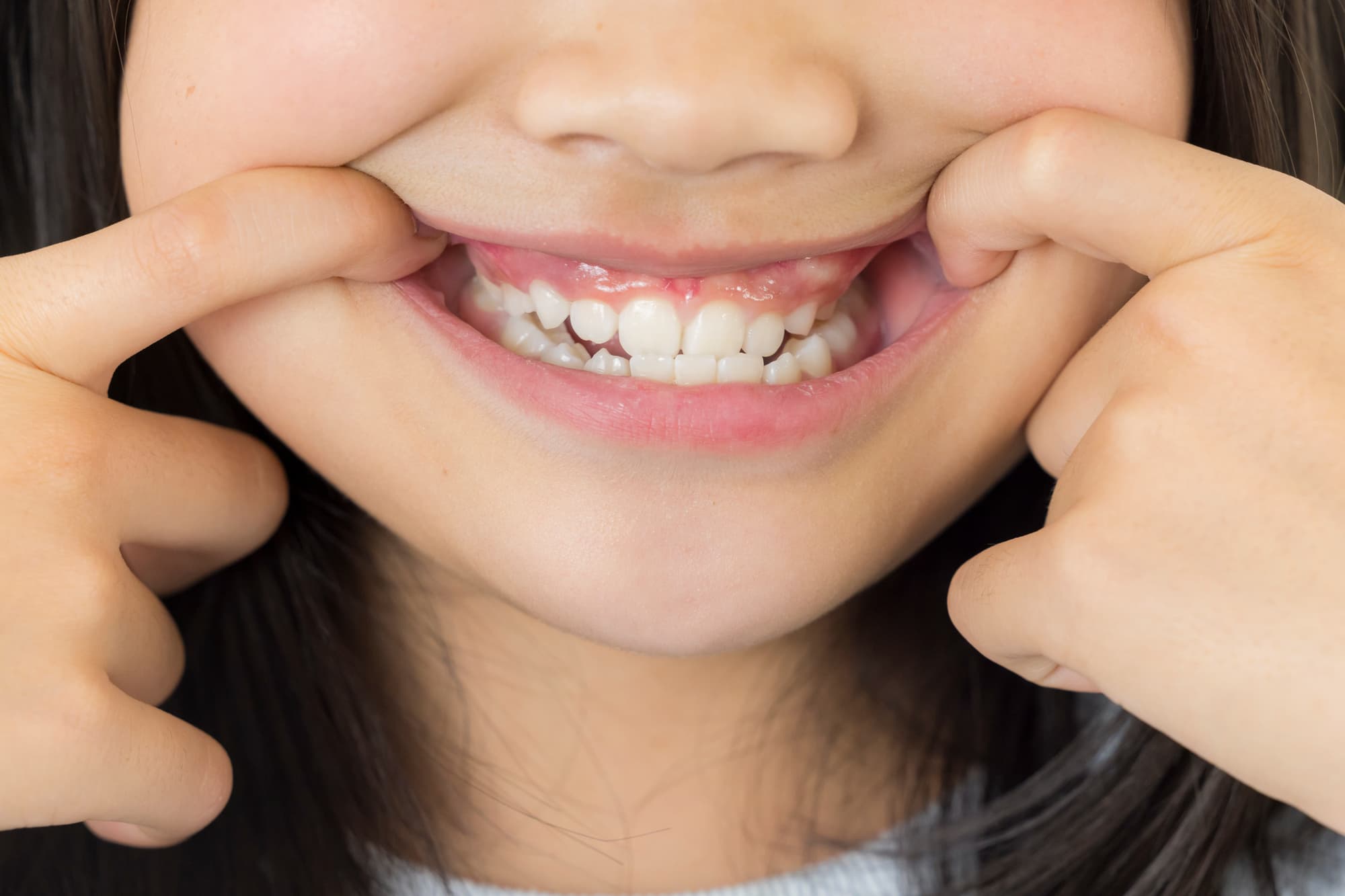 受け口の女の子の歯並び