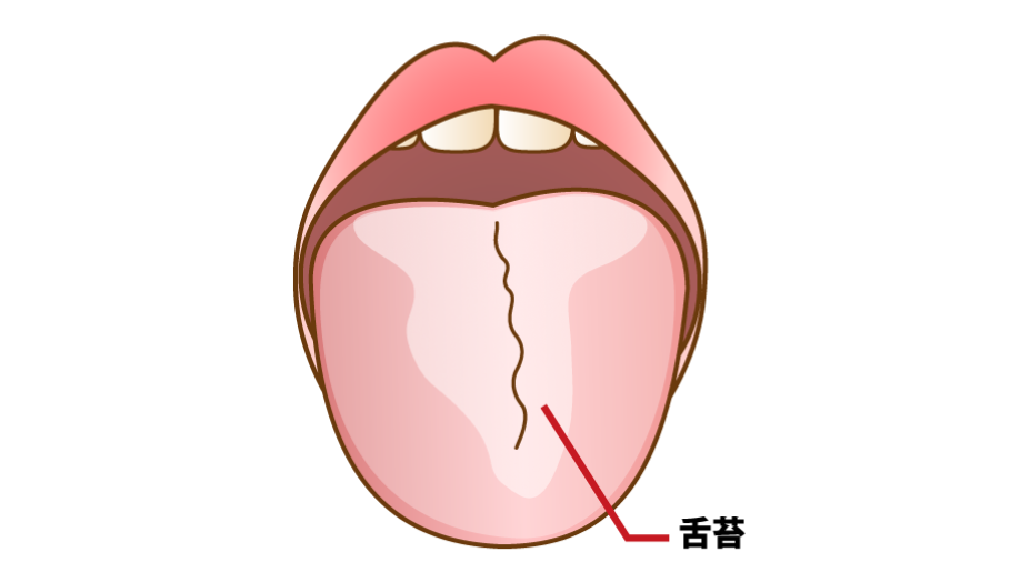 舌苔|すずき歯科