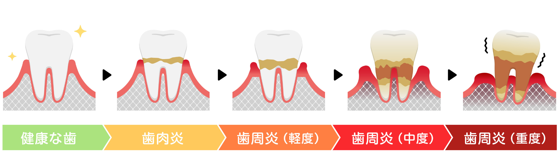 歯周病の進行段階と症状|すずき歯科