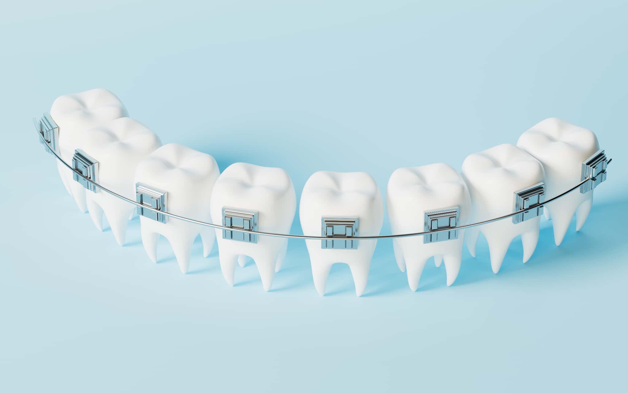 歯の模型に装着したワイヤーとブラケットで種類を説明するイメージ