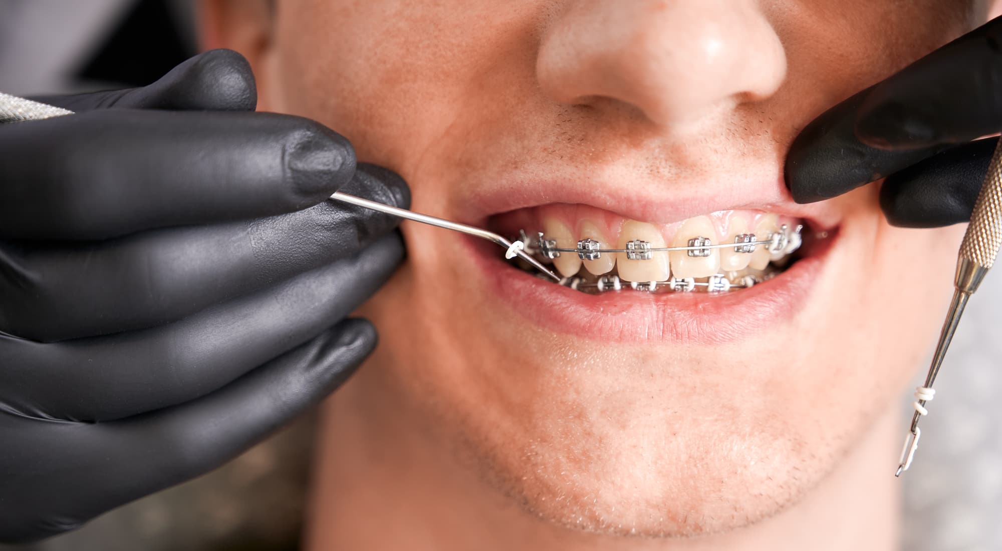 ワイヤー矯正で出っ歯を治療する様子