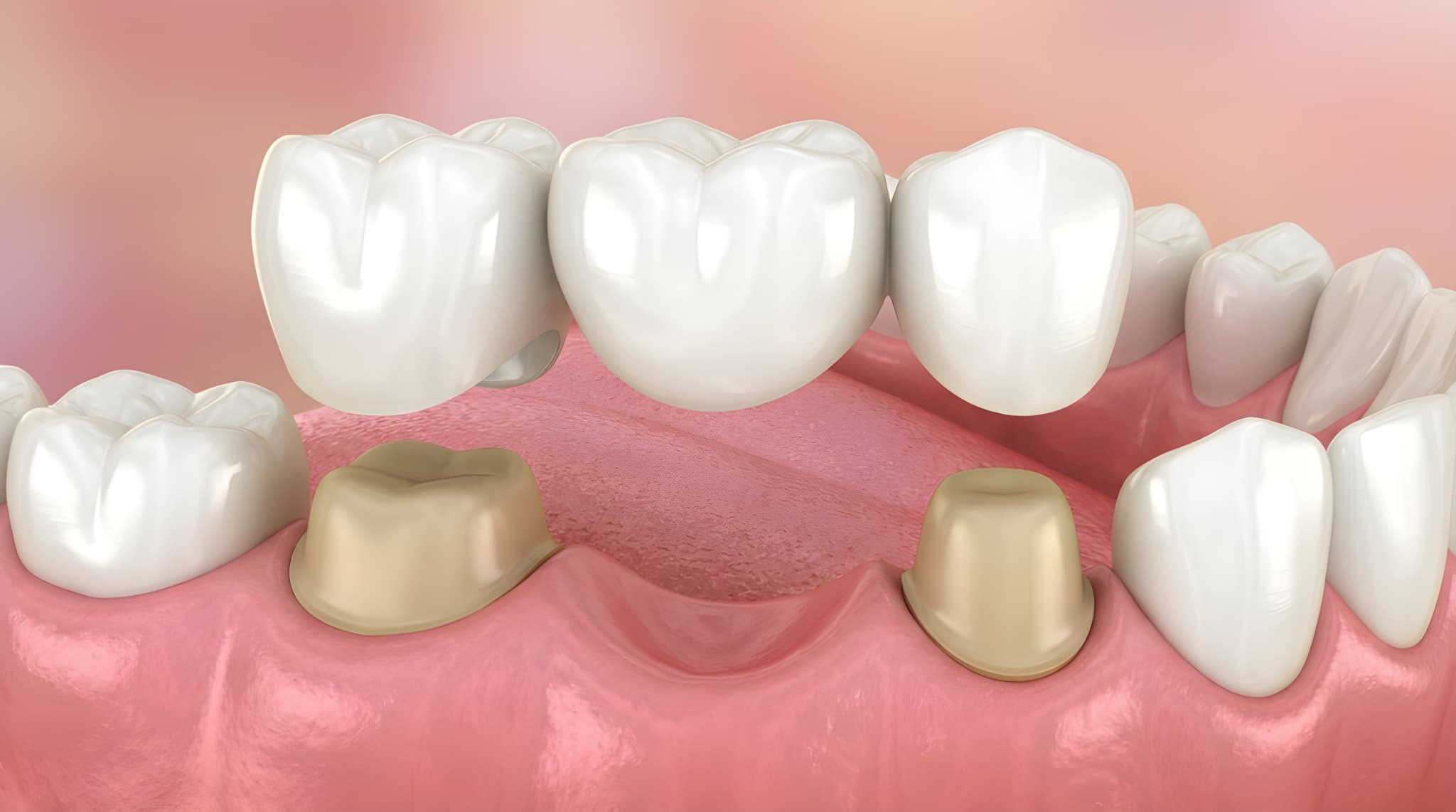 ブリッジ治療の様子