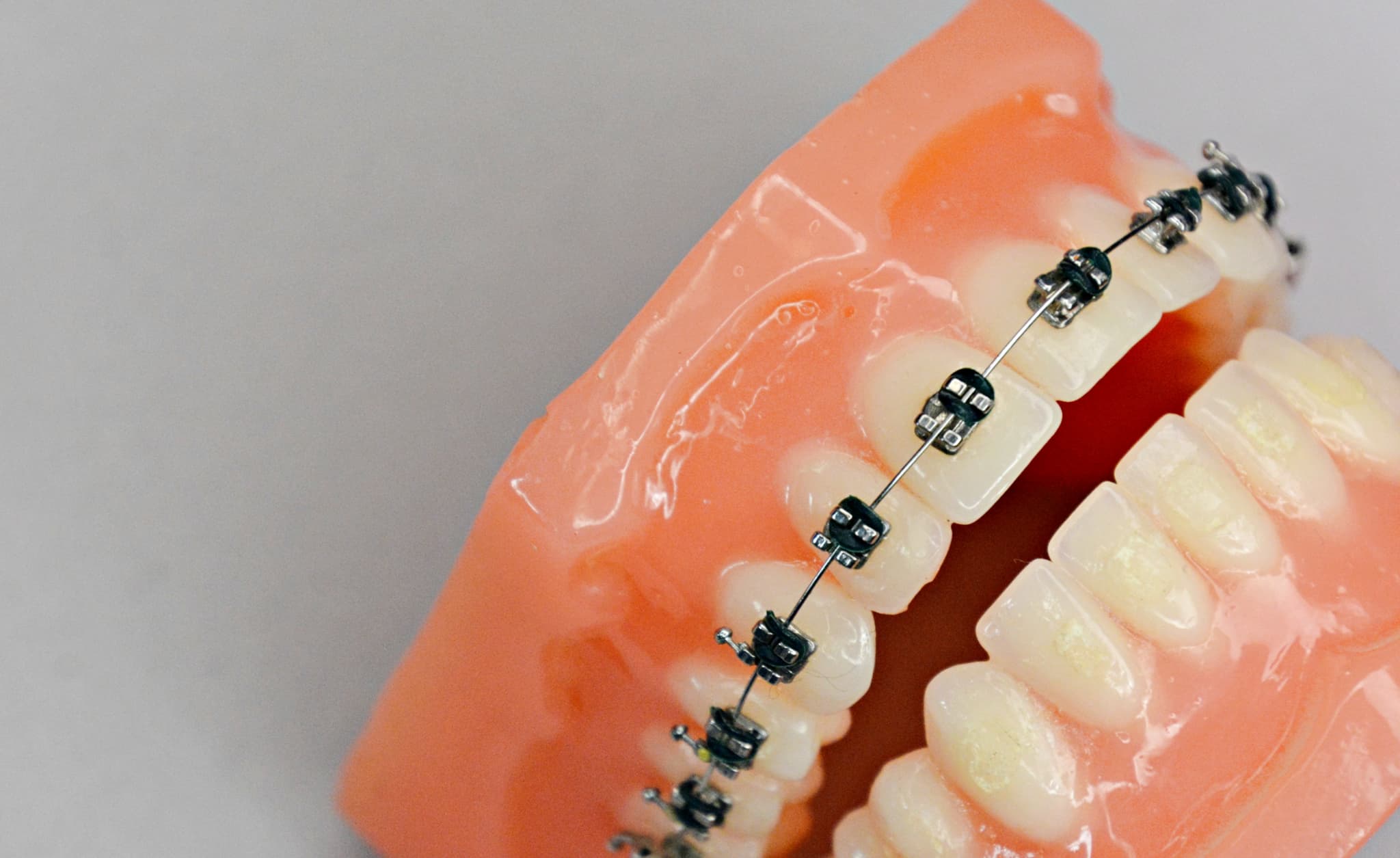 ワイヤー矯正で八重歯を治療する模型