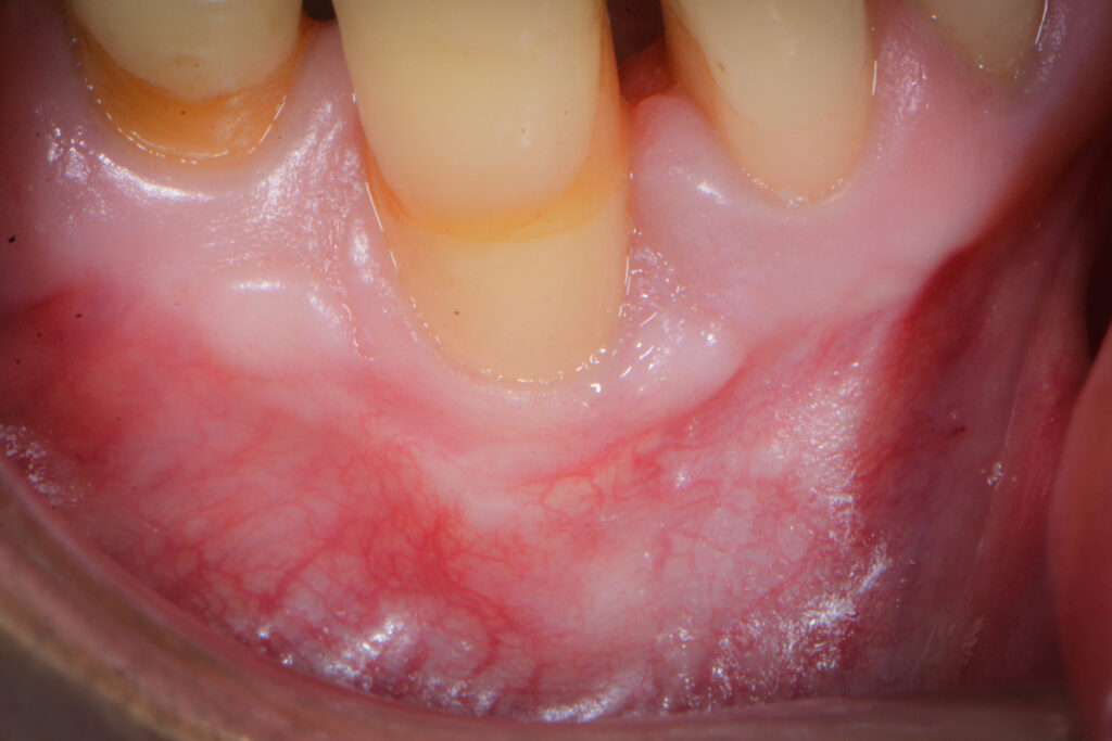 重度の歯周病の主な症状