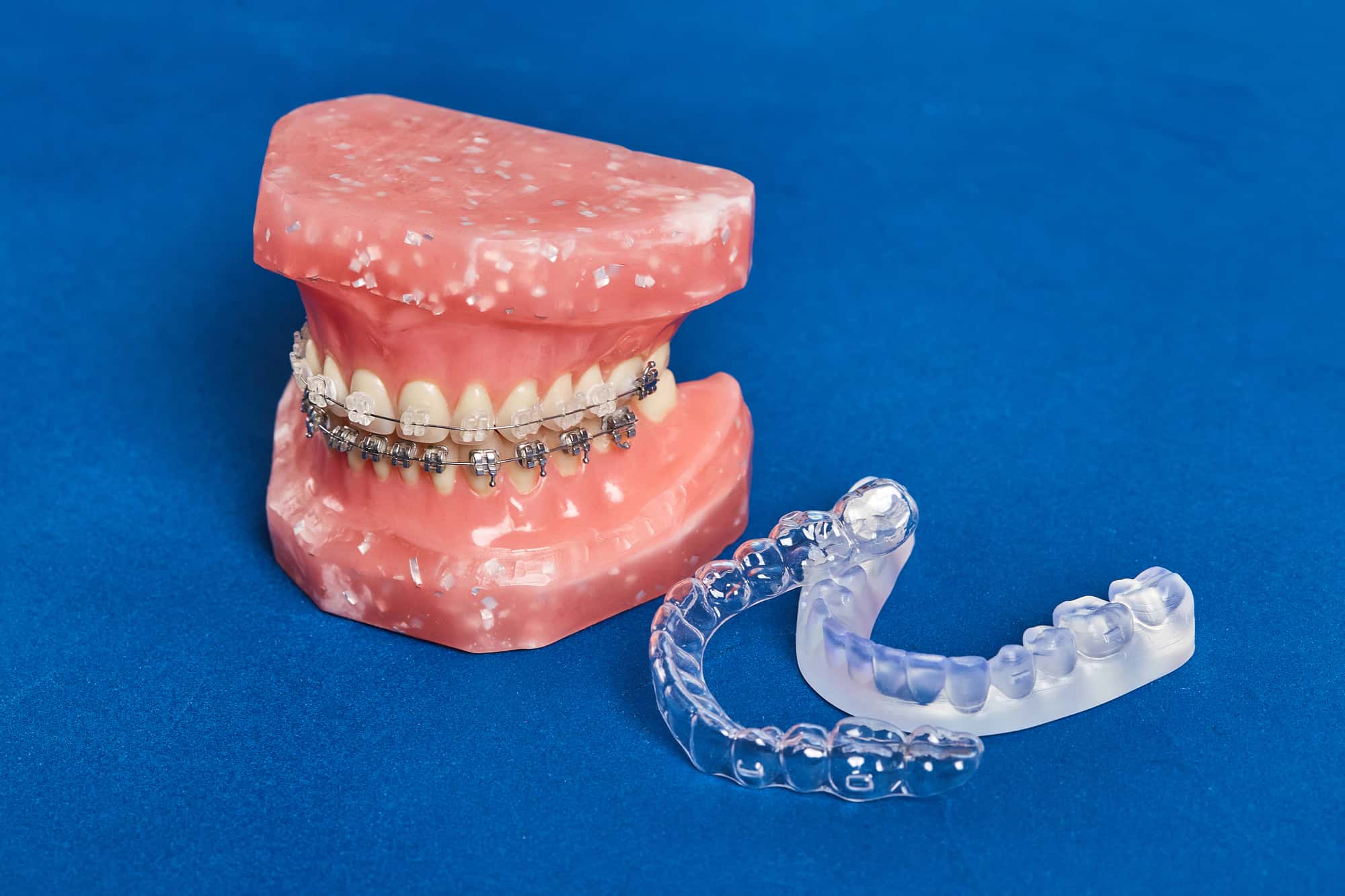 不正咬合を矯正する方法であるワイヤー矯正を装着した歯の模型とマウスピース