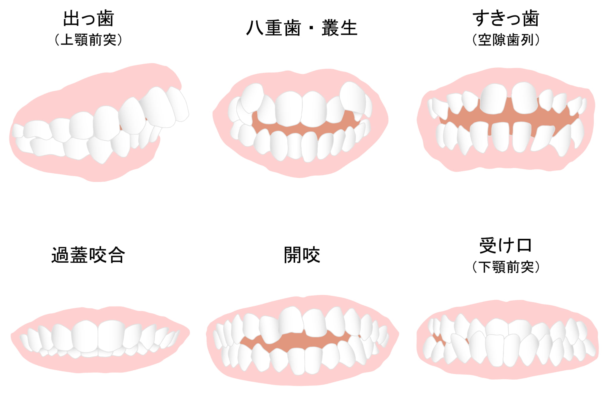 不正咬合の種類の一覧図