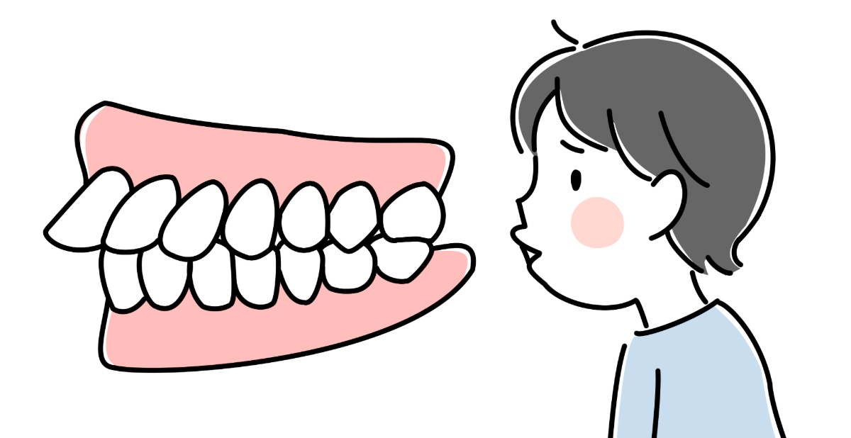 出っ歯とは