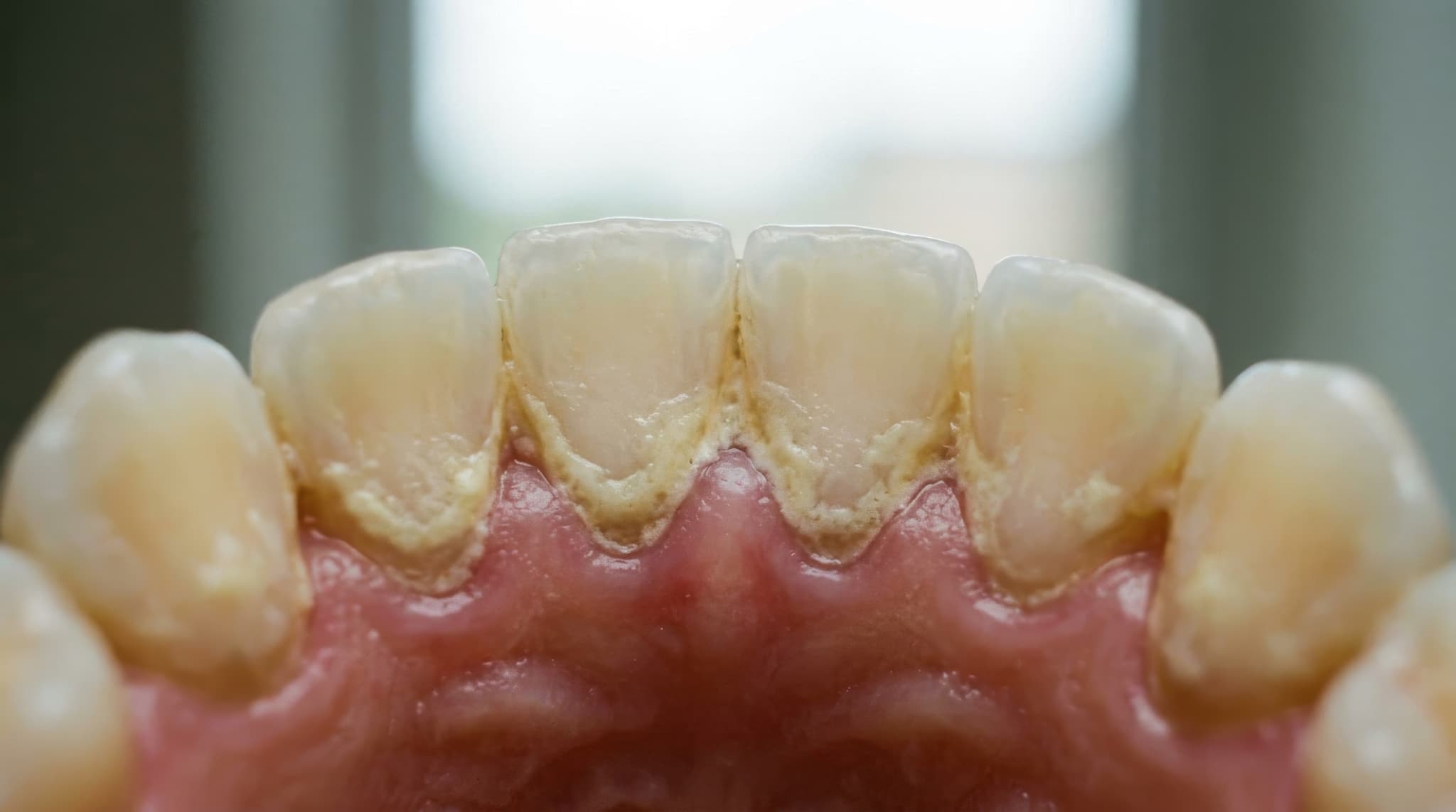 下の前歯の裏側に歯石がついた口腔内の様子